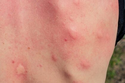 Jak vypadá alergická reakce na pokousání a poštípání hmyzem?